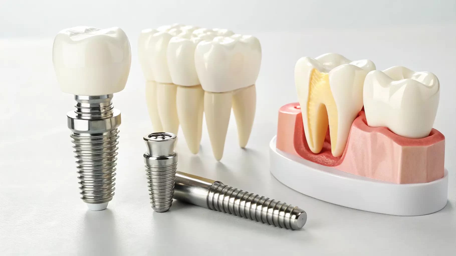 Имплантация зубов: современные решения для идеальной улыбки