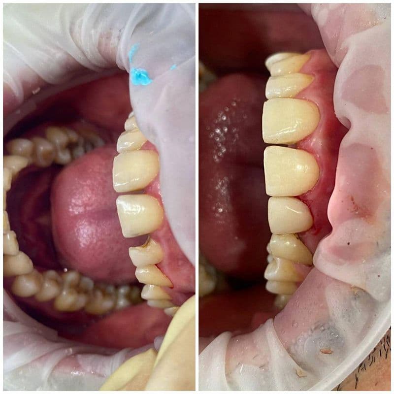 Состояние зубов 2.1 и 2.2 после реставрации