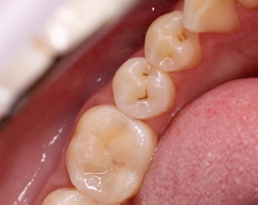 Состояние зубов 2.1 и 2.2 после реставрации