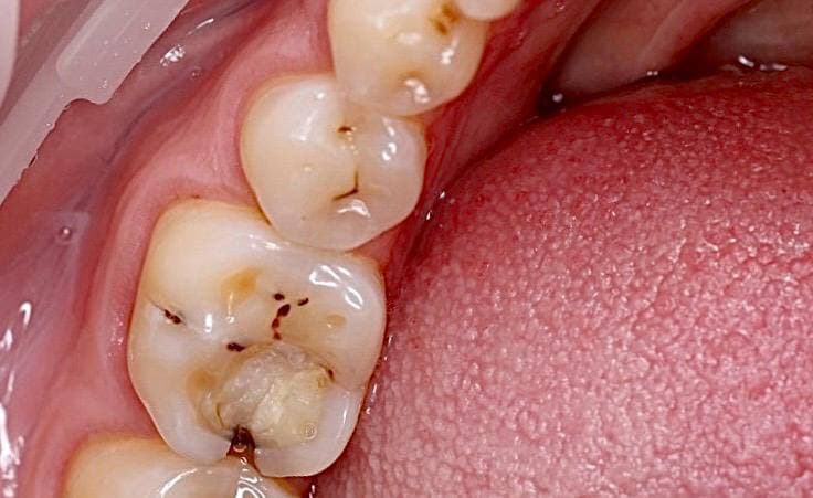 Прямые до реставрации зуба 4.6