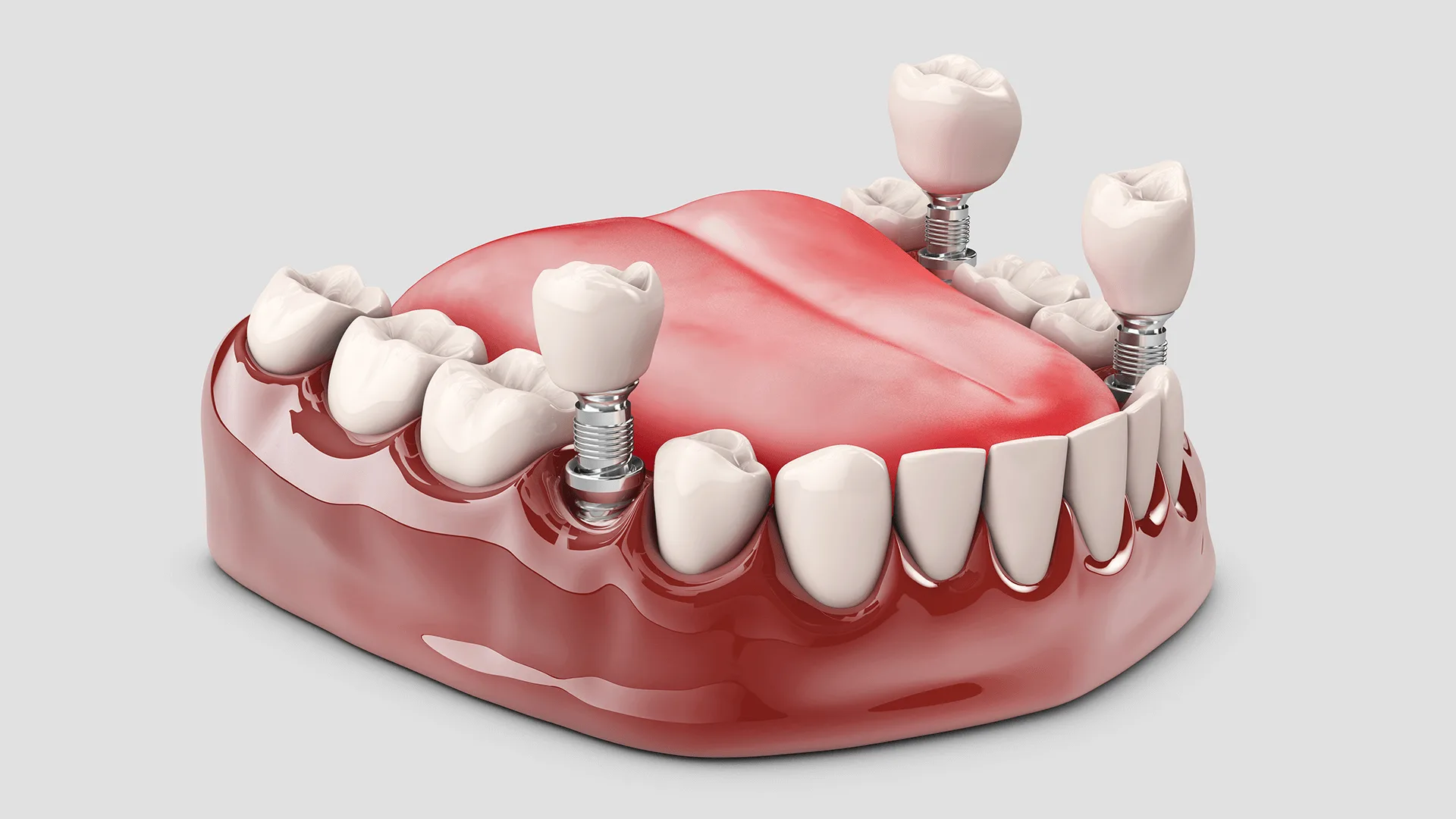 Протезирование зубов